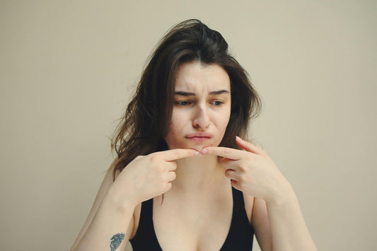 Natural solution against acne